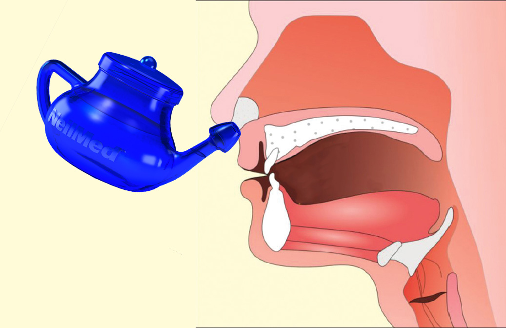 Nasal Irrigation  Michael Rothschild, MD